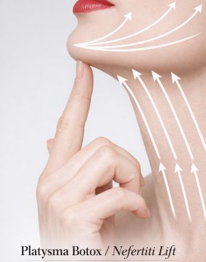  Platysma-Nefertiti lift  (krk & jaw-line)