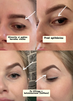 Full Face - celotvárový botulotoxín
