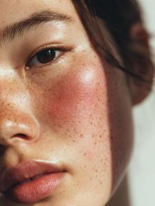 Rosacea & poškodená kožná bariéra