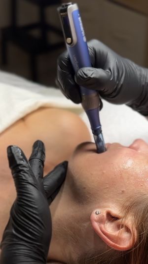 Microneedling (tvár) 2% PN Biostimulant (regeneračné ošetrenie s polynukleotidmi)