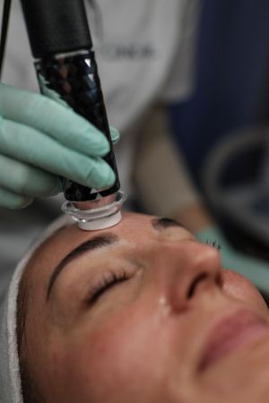 Karboxyterapia 