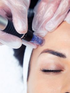 Time stop - microneedling