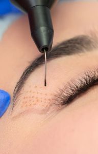 Blefaroplastika viečok / Plazmapero